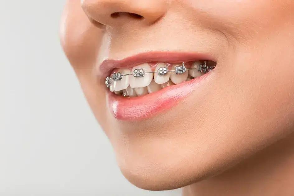 Tipos de brackets: características e vantagens
